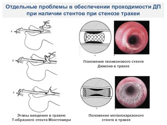 Отдельные проблемы в обеспечении проходимости ДП при наличии стентов при стенозе