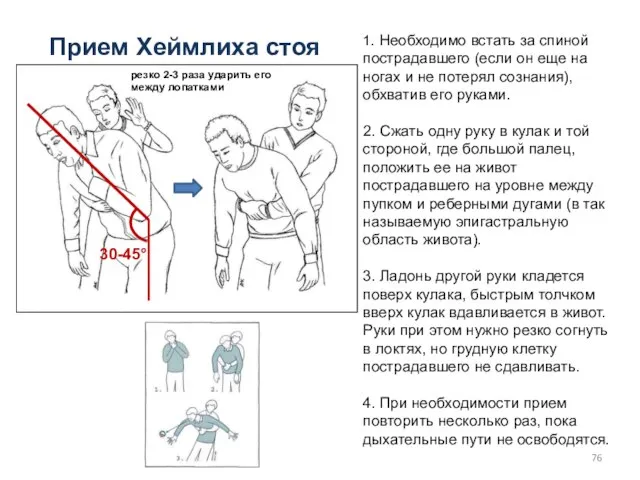 Прием Хеймлиха стоя 1. Необходимо встать за спиной пострадавшего (если он