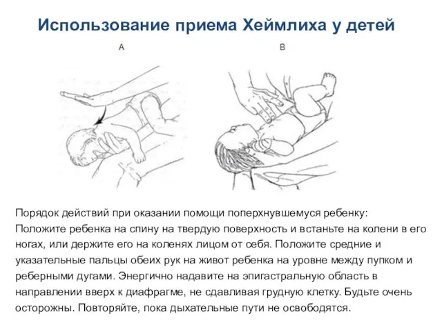 Использование приема Хеймлиха у детей Порядок действий при оказании помощи поперхнувшемуся