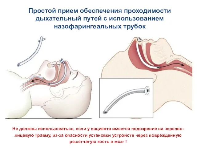 Простой прием обеспечения проходимости дыхательный путей с использованием назофарингеальных трубок Не