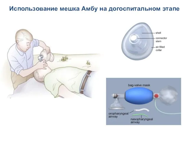 Использование мешка Амбу на догоспитальном этапе