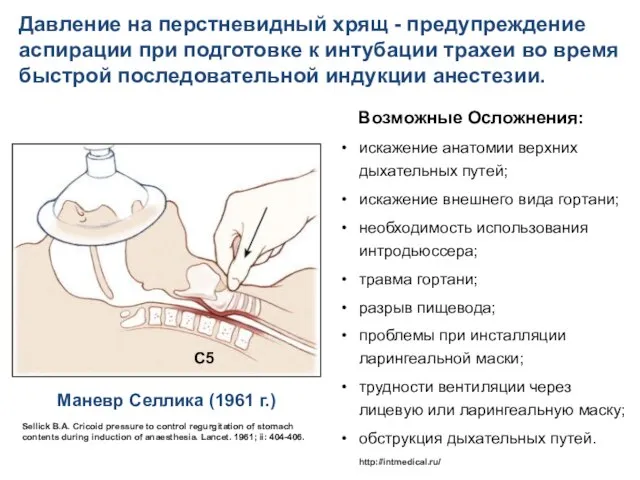 Давление на перстневидный хрящ - предупреждение аспирации при подготовке к интубации