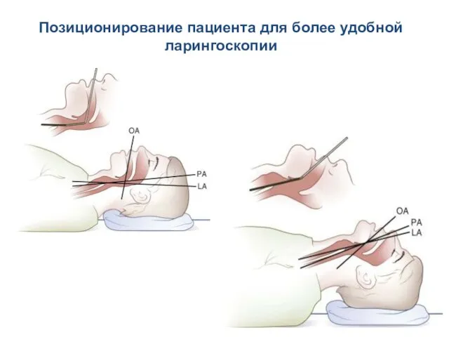 Позиционирование пациента для более удобной ларингоскопии