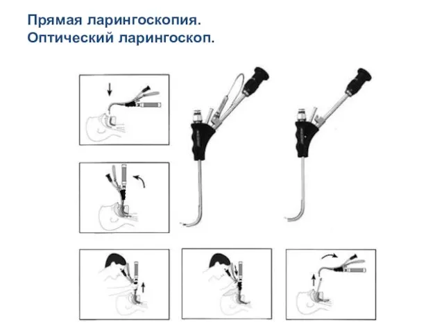 Прямая ларингоскопия. Оптический ларингоскоп.