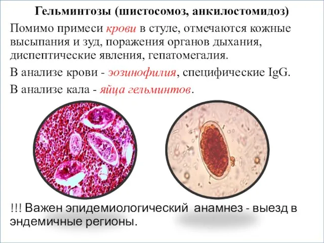 Гельминтозы (шистосомоз, анкилостомидоз) Помимо примеси крови в стуле, отмечаются кожные высыпания