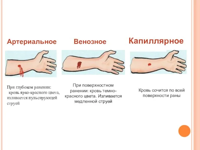 Артериальное При глубоком ранении: кровь ярко-красного цвета, изливается пульсирующей струей Венозное