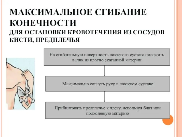 МАКСИМАЛЬНОЕ СГИБАНИЕ КОНЕЧНОСТИ ДЛЯ ОСТАНОВКИ КРОВОТЕЧЕНИЯ ИЗ СОСУДОВ КИСТИ, ПРЕДПЛЕЧЬЯ На