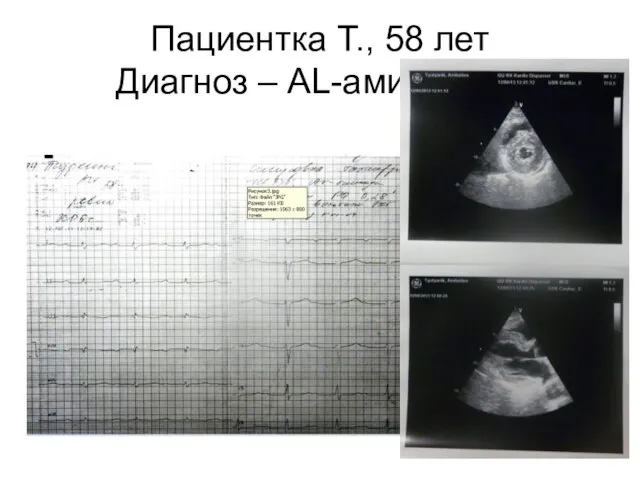 Пациентка Т., 58 лет Диагноз – АL-амилоидоз