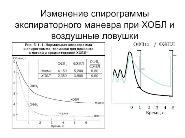 Изменение спирограммы экспираторного маневра при ХОБЛ и воздушные ловушки 0 1