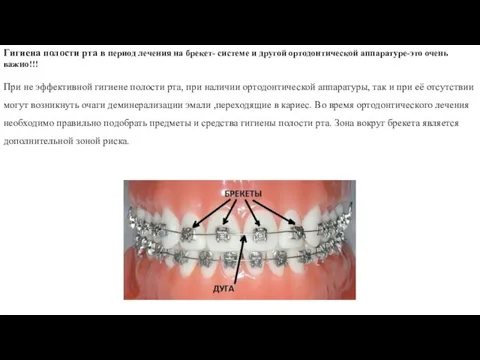 Гигиена полости рта в период лечения на брекет- системе и другой