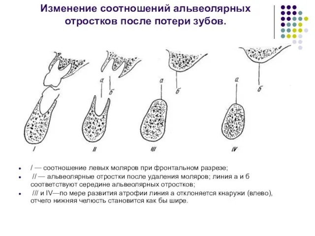 Изменение соотношений альвеолярных отростков после потери зубов. / — соотношение левых