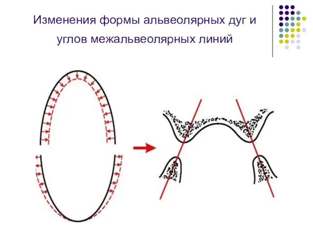 Изменения формы альвеолярных дуг и углов межальвеолярных линий