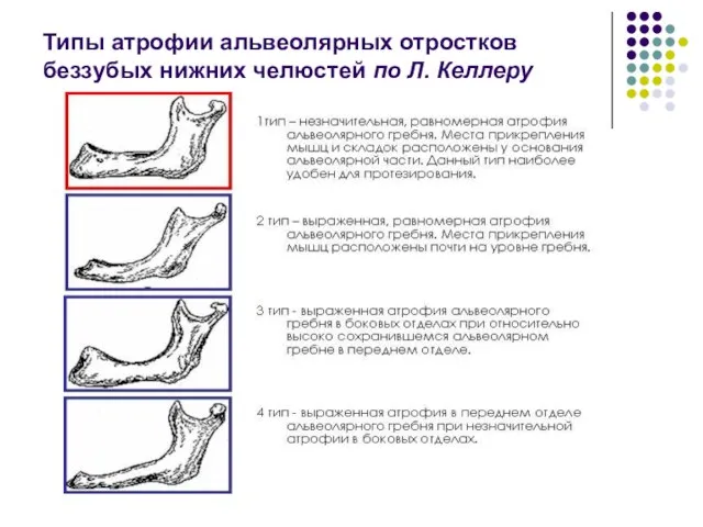 Типы атрофии альвеолярных отростков беззубых нижних челюстей по Л. Келлеру