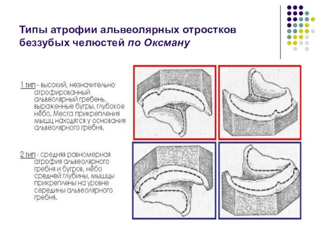 Типы атрофии альвеолярных отростков беззубых челюстей по Оксману