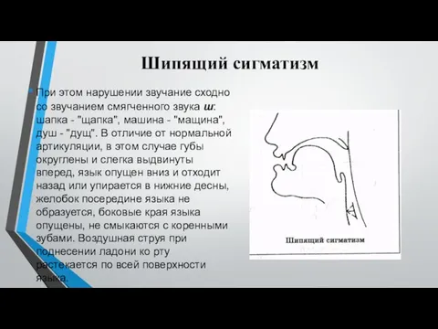 Шипящий сигматизм При этом нарушении звучание сходно со звучанием смягченного звука