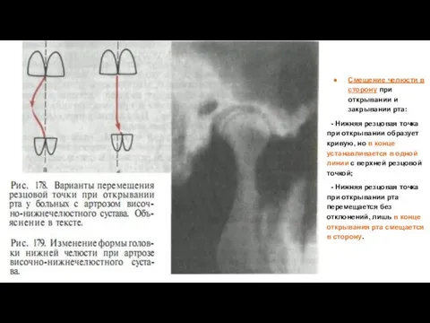 Смещение челюсти в сторону при открывании и закрывании рта: - Нижняя