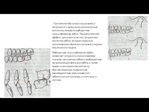 При лечении больных с артрозами, у которых есть нарушения окклюзионных контактов,