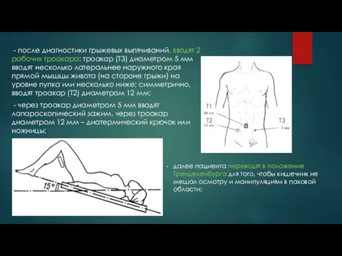 - после диагностики грыжевых выпячиваний, вводят 2 рабочих троакара: троакар (Т3)