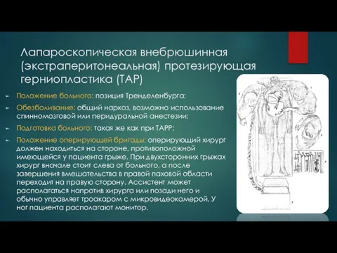 Лапароскопическая внебрюшинная (экстраперитонеальная) протезирующая герниопластика (ТАР) Положение больного: позиция Тренделенбурга; Обезболивание: