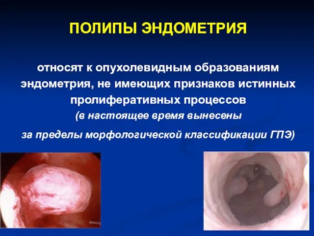 ПОЛИПЫ ЭНДОМЕТРИЯ относят к опухолевидным образованиям эндометрия, не имеющих признаков истинных