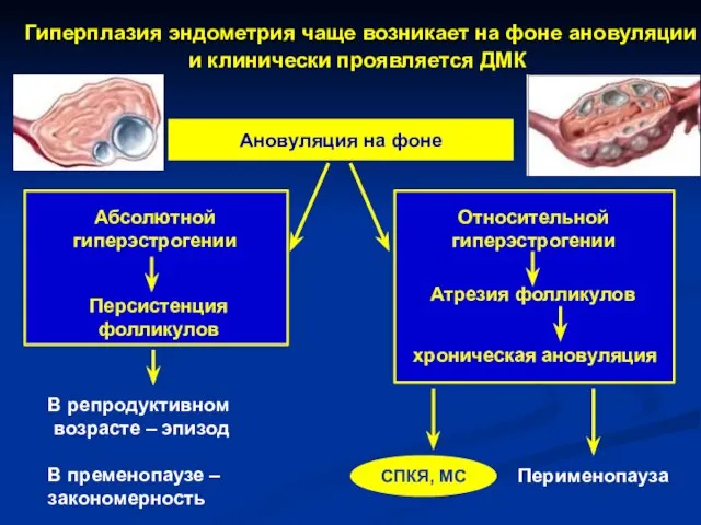 СПКЯ, МС Ановуляция на фоне Гиперплазия эндометрия чаще возникает на фоне