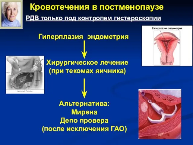 Кровотечения в постменопаузе РДВ только под контролем гистероскопии Гиперплазия эндометрия Хирургическое