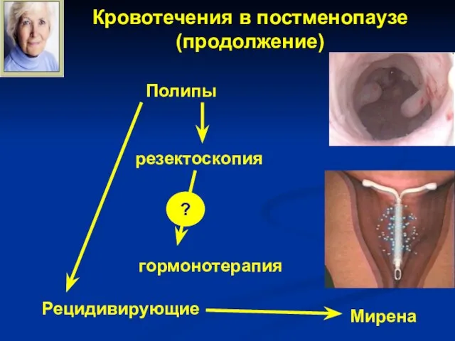 Кровотечения в постменопаузе (продолжение) Полипы резектоскопия Рецидивирующие Мирена ? гормонотерапия