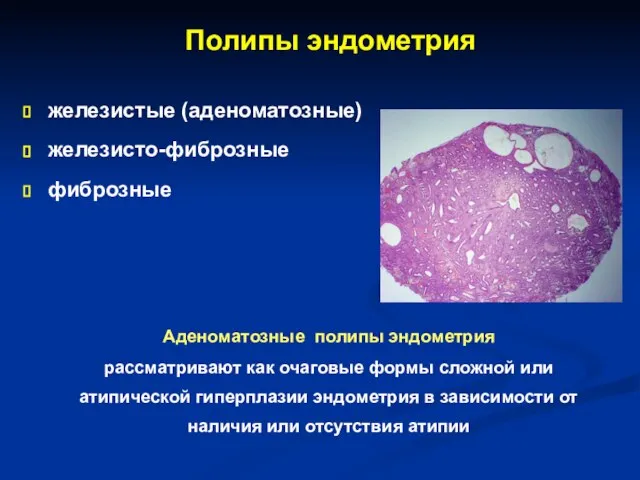 Полипы эндометрия железистые (аденоматозные) железисто-фиброзные фиброзные Аденоматозные полипы эндометрия рассматривают как