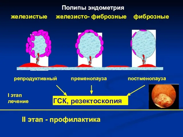 Полипы эндометрия железистые железисто- фиброзные фиброзные репродуктивный пременопауза постменопауза I этап