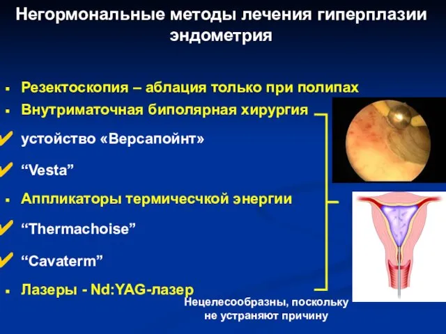 Негормональные методы лечения гиперплазии эндометрия Резектоскопия – аблация только при полипах