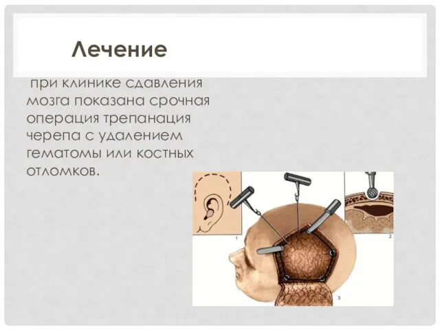 Лечение при клинике сдавления мозга показана срочная операция трепанация черепа с удалением гематомы или костных отломков.