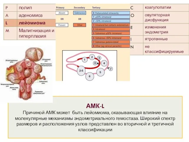 АМК-L Причиной АМК может быть лейомиома, оказывающая влияние на молекулярные механизмы