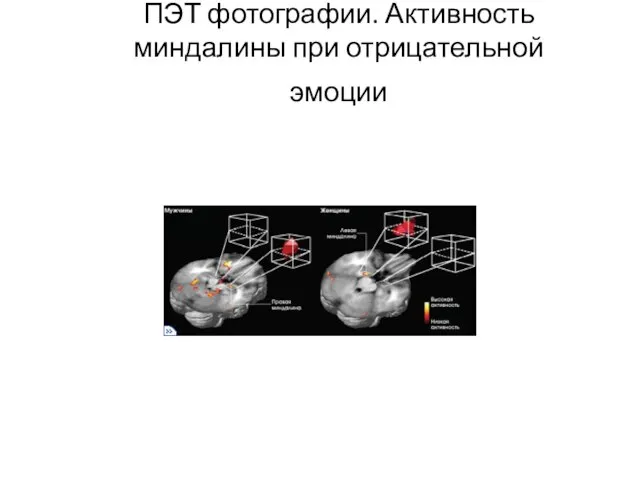 ПЭТ фотографии. Активность миндалины при отрицательной эмоции