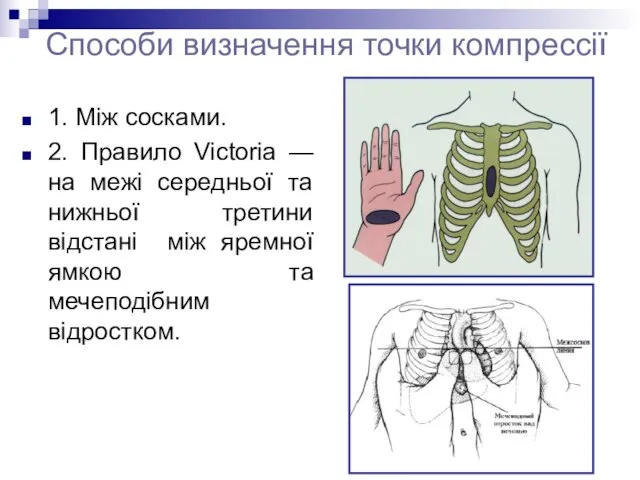 Способи визначення точки компрессії 1. Між сосками. 2. Правило Victoria —