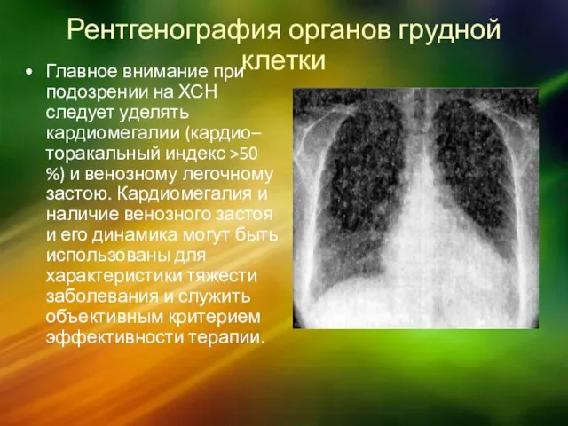 Рентгенография органов грудной клетки Главное внимание при подозрении на ХСН следует