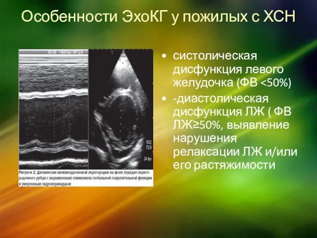 Особенности ЭхоКГ у пожилых с ХСН систолическая дисфункция левого желудочка (ФВ