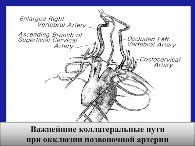Важнейшие коллатеральные пути при окклюзии позвоночной артерии