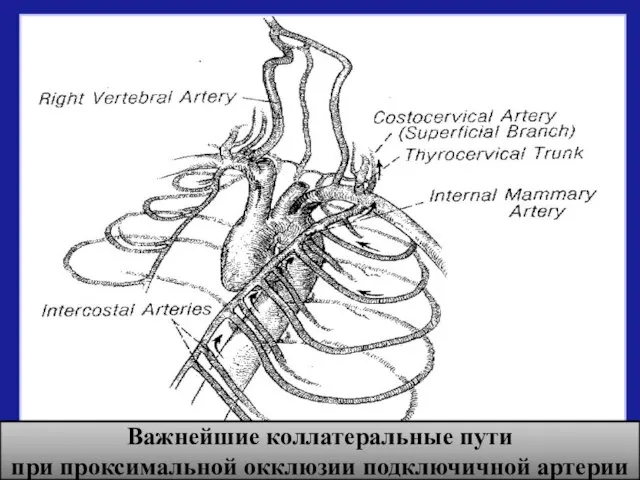 Важнейшие коллатеральные пути при проксимальной окклюзии подключичной артерии