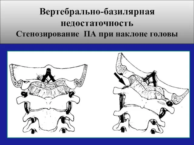 Вертебрально-базилярная недостаточность Стенозирование ПА при наклоне головы