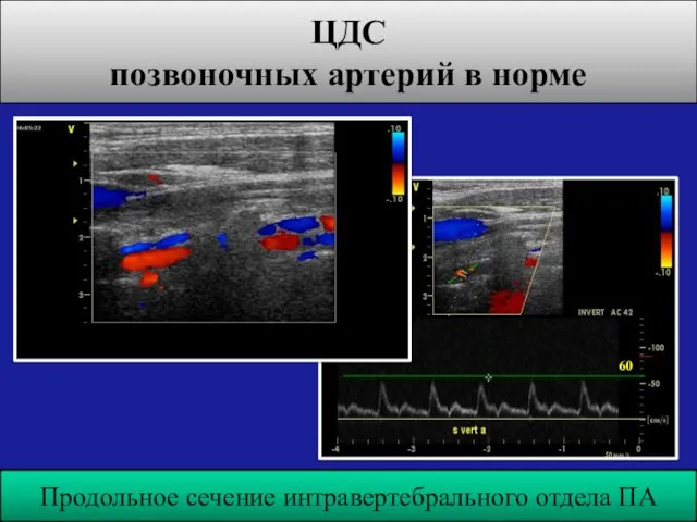 ЦДС позвоночных артерий в норме Продольное сечение интравертебрального отдела ПА 60