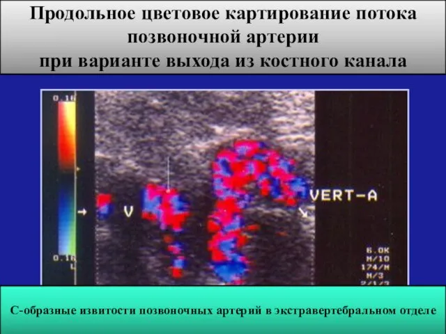 Продольное цветовое картирование потока позвоночной артерии при варианте выхода из костного