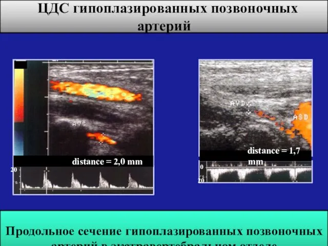 ЦДС гипоплазированных позвоночных артерий distance = 2,0 mm 20 distance =