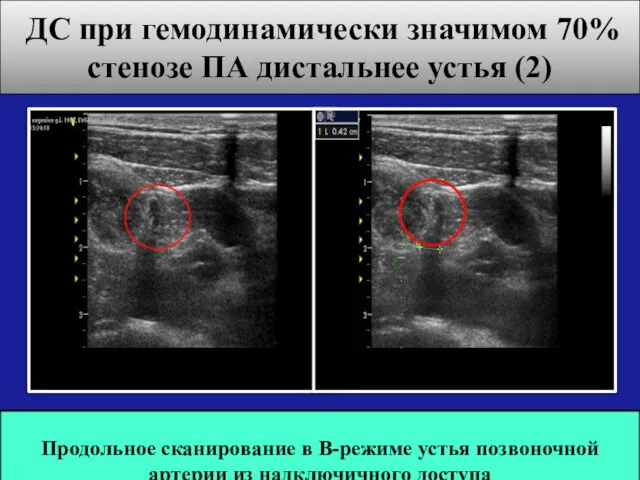 ДС при гемодинамически значимом 70% стенозе ПА дистальнее устья (2) Продольное