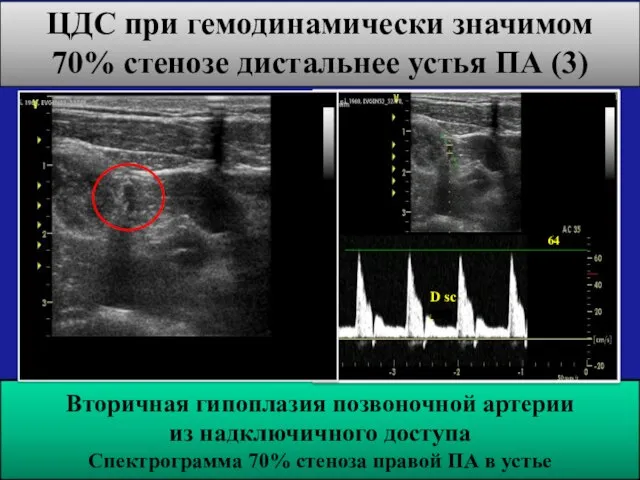 ЦДС при гемодинамически значимом 70% стенозе дистальнее устья ПА (3) Вторичная