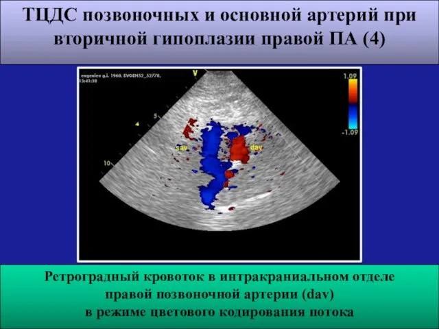 ТЦДС позвоночных и основной артерий при вторичной гипоплазии правой ПА (4)