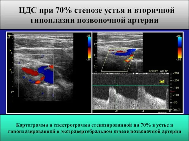 ЦДС при 70% стенозе устья и вторичной гипоплазии позвоночной артерии Картограмма