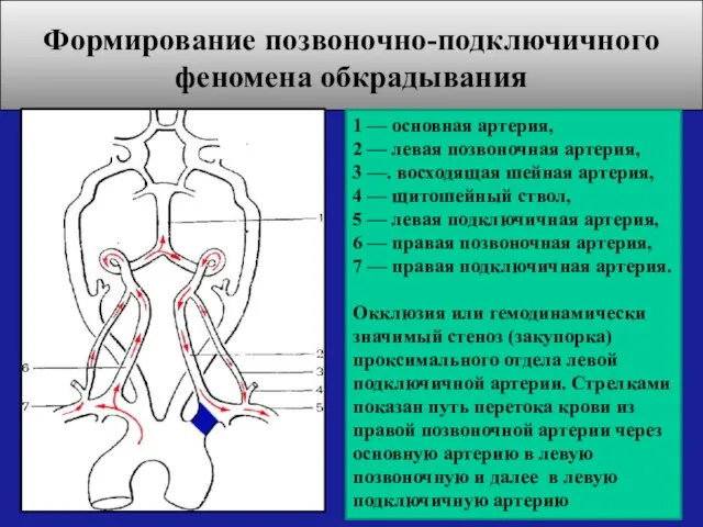1 — основная артерия, 2 — левая позвоночная артерия, 3 —.