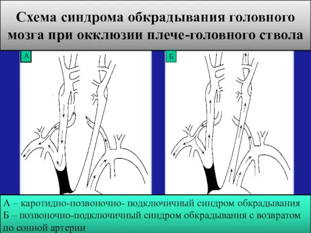 А Схема синдрома обкрадывания головного мозга при окклюзии плече-головного ствола Б