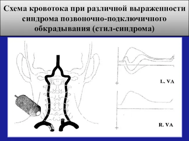 Схема кровотока при различной выраженности синдрома позвоночно-подключичного обкрадывания (стил-синдрома) + +