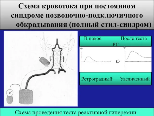 Схема кровотока при постоянном синдроме позвоночно-подключичного обкрадывания (полный стил-синдром) Схема проведения